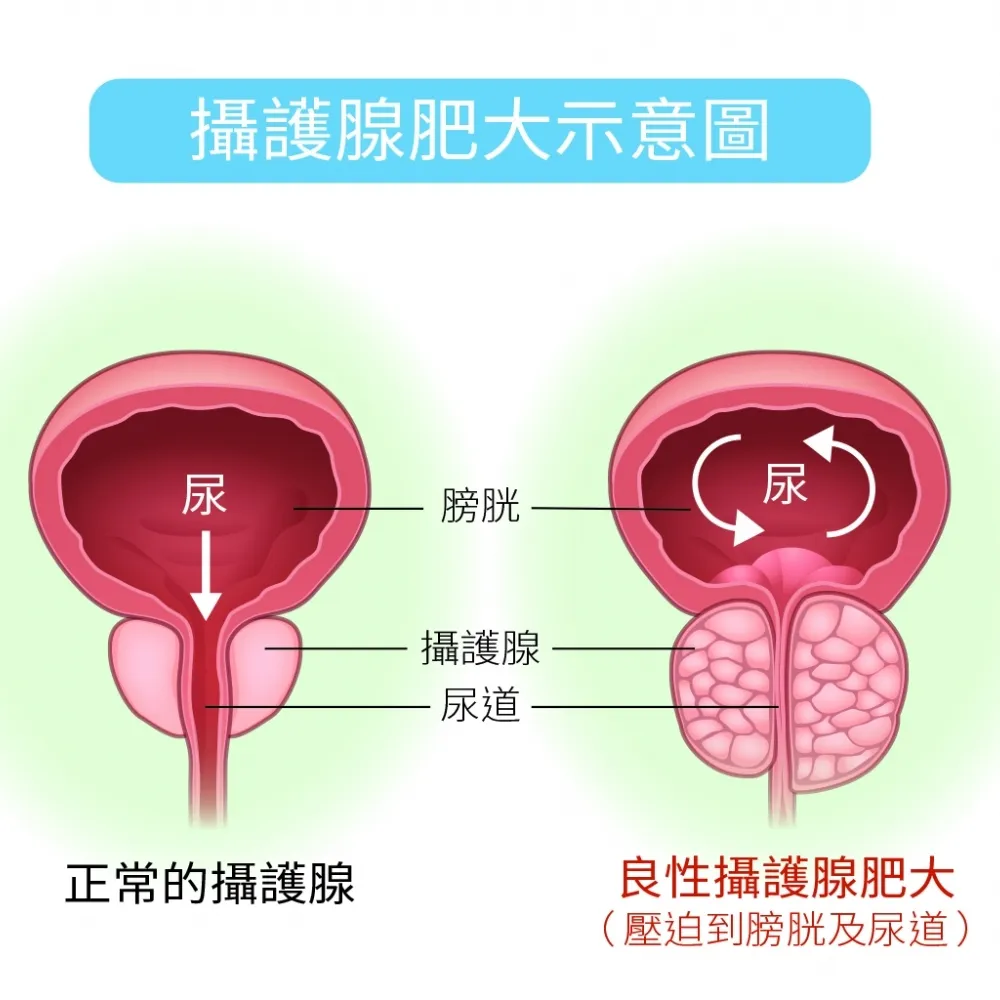 攝護腺手術詳情