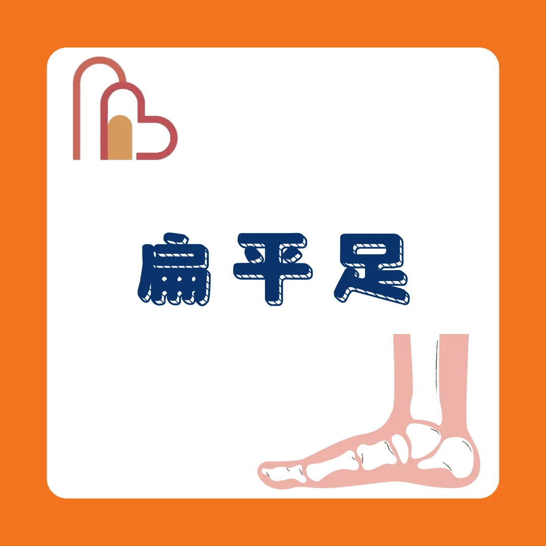 扁平足 (Flat feet)